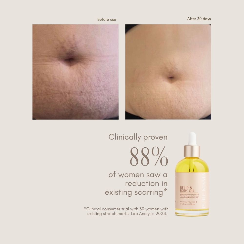 Side-by-side photos show a stomach with stretch marks before and after 30 days of using Pure Mama NZ Belly & Body Oil. Text states 88% of women saw reduced scarring. A bottle of the oil appears at the bottom.