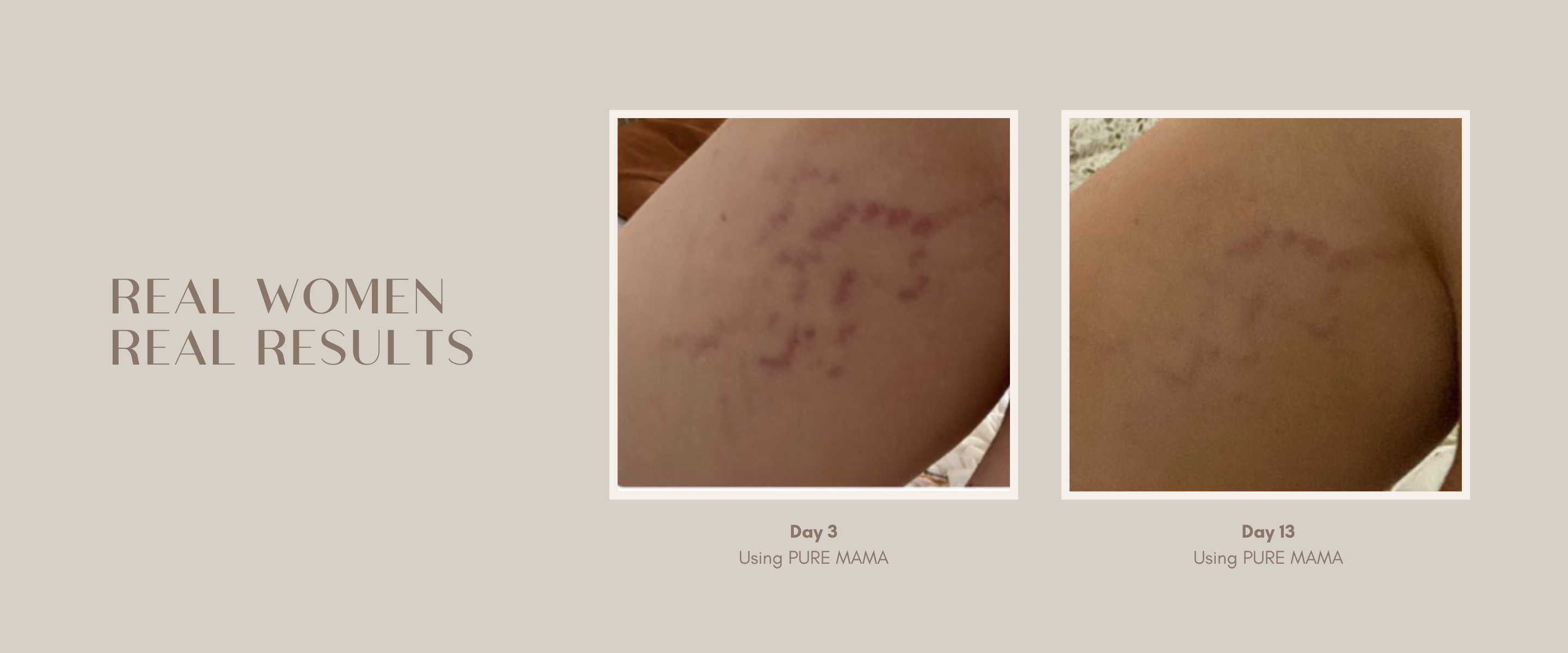 Stretch Mark Belly Oil 100 Natural PURE MAMA Skincare