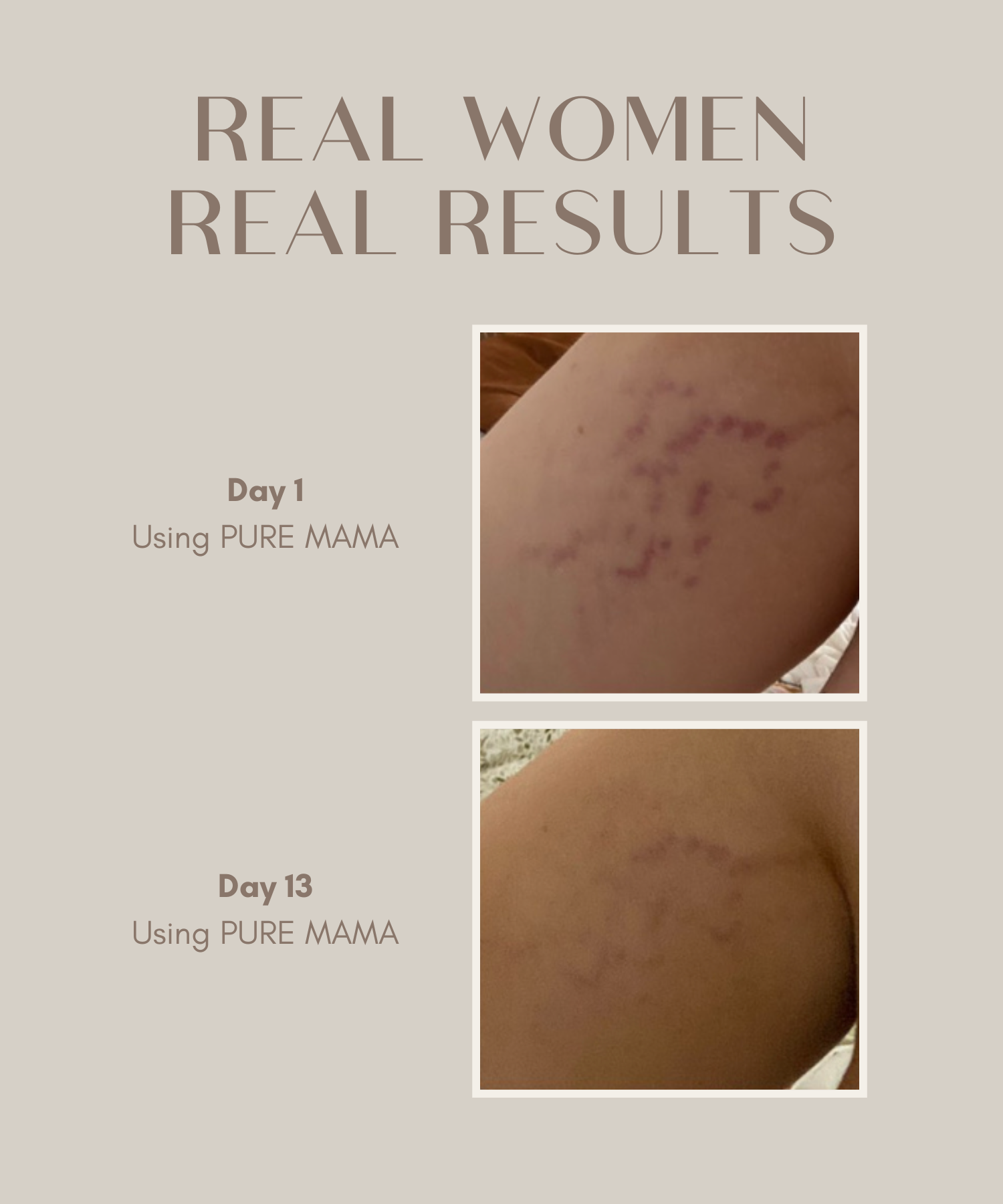 Stretch Mark Belly Oil 100 Natural PURE MAMA Skincare