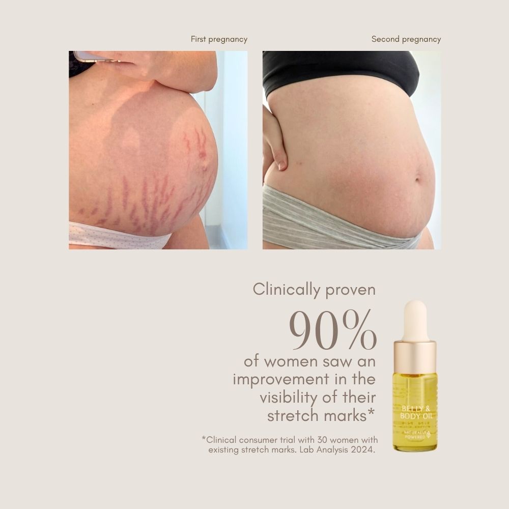 Side-by-side comparison of a pregnant belly with more red stretch marks in the first pregnancy and fewer in the second, alongside Pure Mama NZ Belly Oil Mini and text highlighting improved pregnancy skincare and reduced stretch marks.