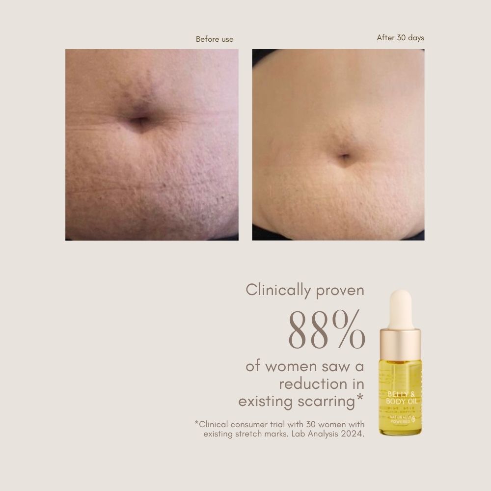 Two side-by-side photos show stretch marks before and after 30 days using Pure Mama NZ Belly Oil Mini. Text highlights an 88% reduction in scarring—ideal for pregnancy skincare. A yellow Pure Mama NZ bottle appears below.