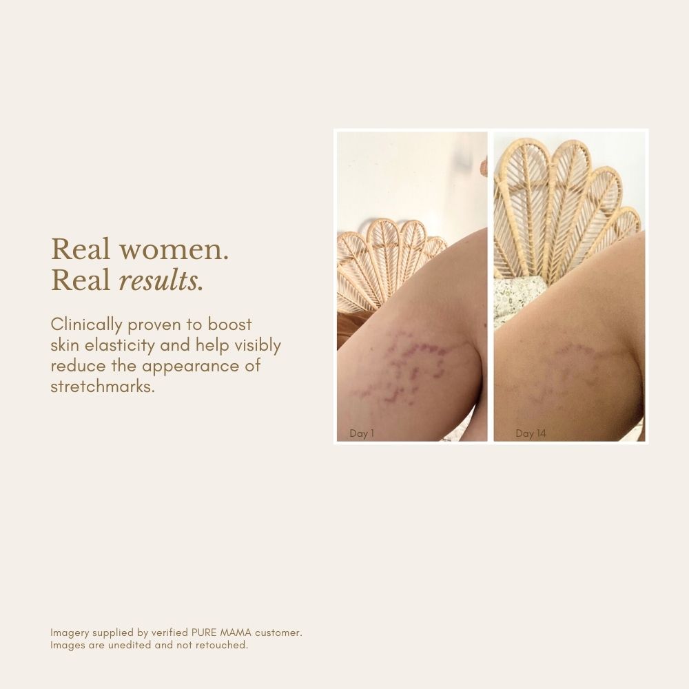 Side-by-side photos of a woman’s upper arm show stretch marks on day 1 and visibly faded marks on day 14. Text reads: Pure Mama NZ Stretch Mark Belly Oil is clinically proven to boost skin elasticity and reduce stretch marks—even after pregnancy.