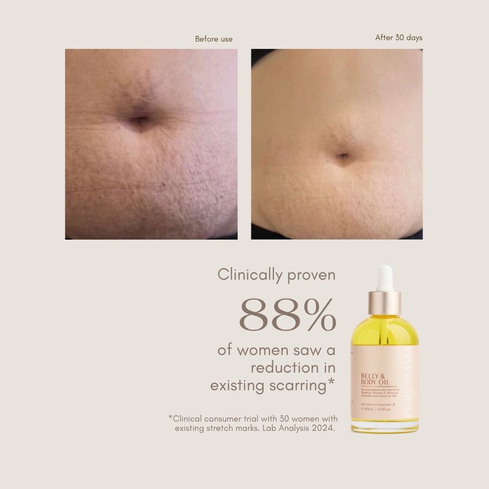 Side-by-side close-up photos of a person’s stomach show reduced scarring and improved skin elasticity after 30 days of using Pure Mama NZ Stretch Mark Belly Oil. Text states 88% of women saw scar reduction. A dropper bottle is shown below.