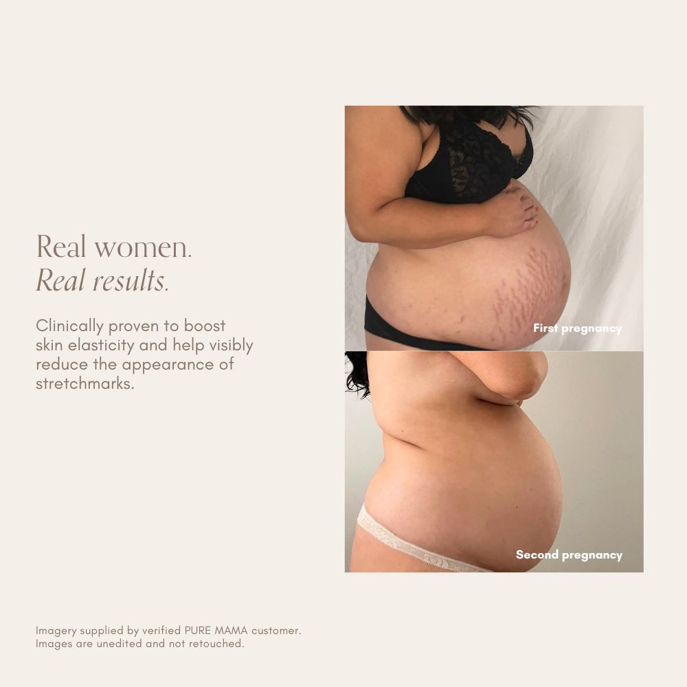 Side-by-side images show a pregnant woman in lingerie during both pregnancies. Text reads, Real women. Real results, highlighting reduced stretch marks and improved skin elasticity with Pure Mama NZ Stretch Mark Belly Oil.